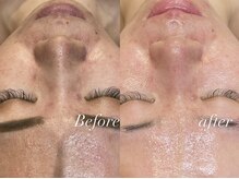 レシェルサロン(Lechelle Salon)/ニキビ　ハーブピーリング＋OP