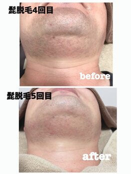 ビジュク(B-juku)/メンズ髭（ビフォーアフター）