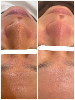 ル シェリア(Le Cherien)/毛穴洗浄