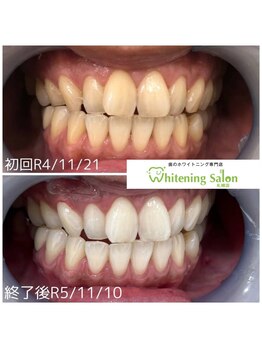 ホワイトニングサロン 札幌店/【ホワイトニング】#札幌#大通り