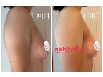 美バストアルファ(美bust α)/【光豊胸】症例