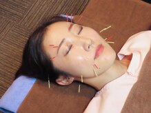 リカバリー整体院 太宰府院/美容鍼