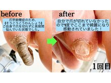 亀太郎鍼灸整体院 津志田院/根本改善の巻き爪施術！