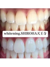 シロハ(SHIROHA)/セルフホワイトニング/天王寺