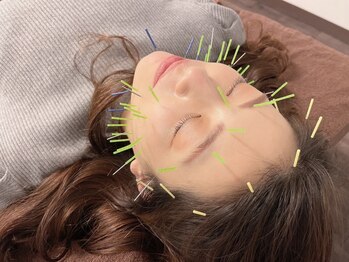 ベレディオ鍼灸整骨院(Belledio鍼灸整骨院)/肌荒れ、リフトアップ、小顔効果