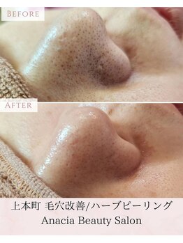 アナシアビューティーサロン(Anacia)/毛穴エクストラクション