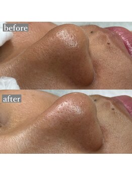 ライカブルー(RaicA BluE)/施術写真