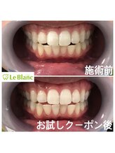 ルブラン 奈良店(Le Blanc)/大事なお口元！