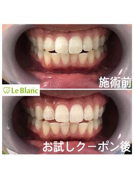 ルブラン 奈良店(Le Blanc)/大事なお口元!