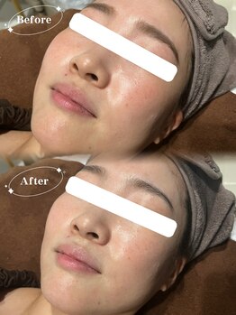 ソア(Soa)/美白マグネットパック×毛穴洗浄