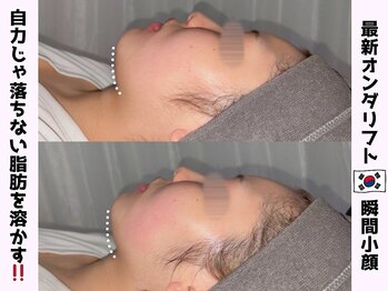 オンダリフト東京　大阪梅田店【韓国肌管理】オンダリフト/ララ ピール/小顔矯正/痩身/オンダリフト/梅田/ララピール