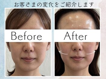 さくら鍼灸院 整骨院/美容鍼7