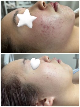 リクラ 北千住(Reclat)/ハーブピーリングオーダーメイド