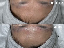 ナチュールムーン(Nature moon.)/ハーブピーリング