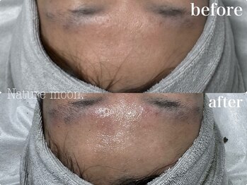 ナチュールムーン(Nature moon.)/ハーブピーリング