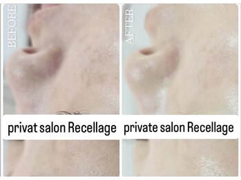 リセラージュ(Recellage)/陶肌トリートメント×グロッティ