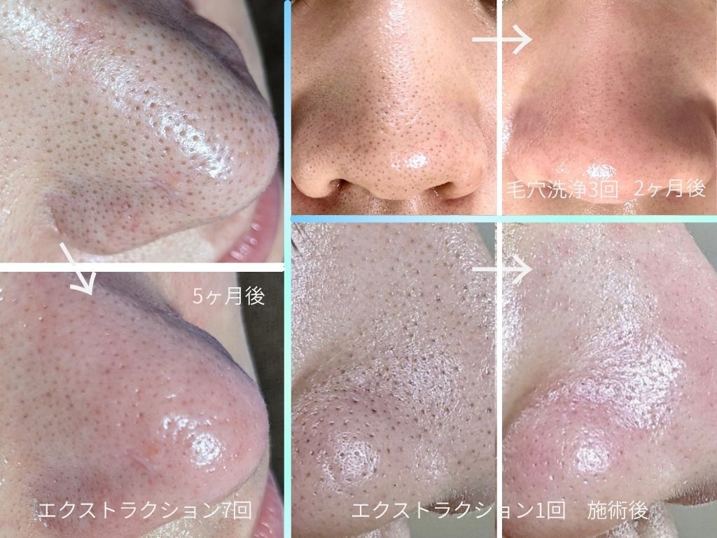 福岡県で毛穴ケアが人気のエステサロン｜ホットペッパービューティー