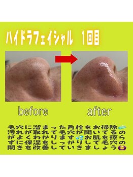 ワイズ(Y’s)/ハイドラフェイシャル☆