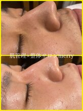 メリー 大和西大寺店(merry)/ハーブピーリングで本気の肌改善