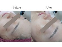 ココロ(COCORO)/(施術前後)シルクエピレーション