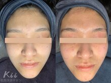 キー(kii)/敏感肌にもハーブピーリング