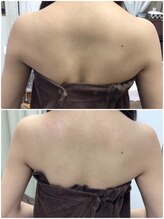 アルカンジュ(Archange)/ハイパー痩身〈ブライダル背中〉