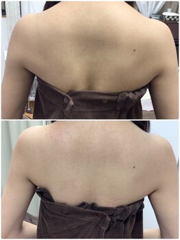 アルカンジュ(Archange)/ハイパー痩身〈ブライダル背中〉