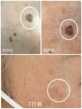 ブライズ(BRISE)/シミケア