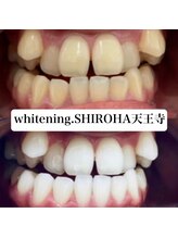 シロハ(SHIROHA)/セルフホワイトニング/天王寺