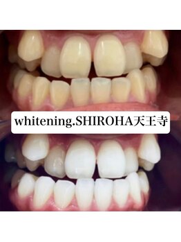 シロハ(SHIROHA)/セルフホワイトニング/天王寺