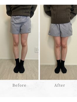 エール シガ(AILE SHIGA)/O脚矯正・歪み・ねじれを美脚に