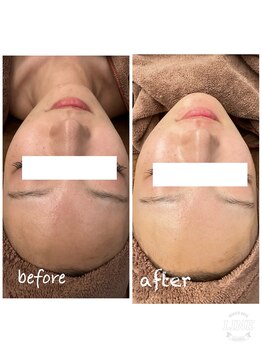 シエル ブルー(Ciel Blue)/肌質改善