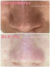 ビエル(Bielle)/【本気の開き毛穴改善】白毛穴へ