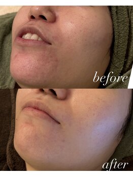 エル(Elle)/【肌改善】乾燥/赤み/敏感肌