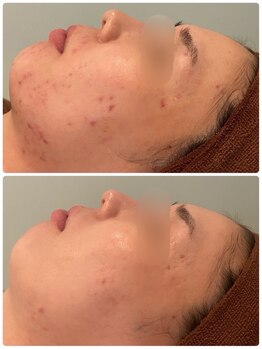 ビオエル 横浜店(Bioel)/ハーブピーリング/横浜