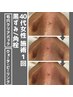 人気No2【頑固角栓・黒ずみ徹底オフ】毛穴洗浄でツルツル美肌/開き毛穴◎70分