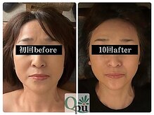 キュープ 鹿児島伊集院店(Qpu)/小顔矯正10回での変化