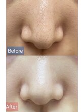 ミャオ(Meow!)/毛穴洗浄/ハイドラ/毛穴ケア