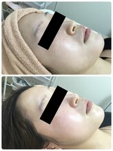 メイユール(MEILLEUR)/光フェイシャル1回＋スキンケア