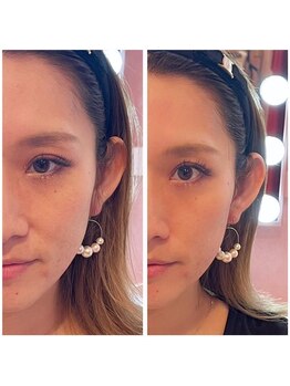 ワイズサロン(Y's salon)/フェイシャル症例2♪