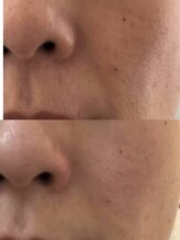 ラエッセ 恵比寿(LAESSE)/毛穴・美白専門店 LAESSE 恵比寿