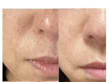 スパークル/フェイシャル