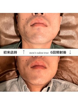 トゥルー(true)/ヒゲ脱毛 7回照射