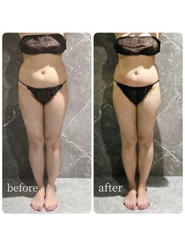 インディバ 六本木/【腹腰集中痩身】before→after