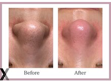 クロス(Xcross)/毛穴ケア【毛穴/代官山/渋谷】