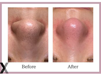 クロス(Xcross)/毛穴ケア【毛穴/代官山/渋谷】