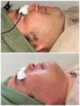 ネオズエゴ アーチ(neos ego Archi)/メンズヒゲ脱毛