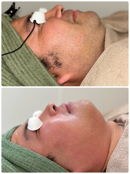 ネオズエゴ アーチ(neos ego Archi)/メンズヒゲ脱毛