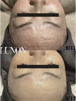 ルノン(Lunon)/肌質改善《症例》