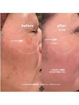 エン(EN)/シミ/毛穴/くすみ改善!美肌体験